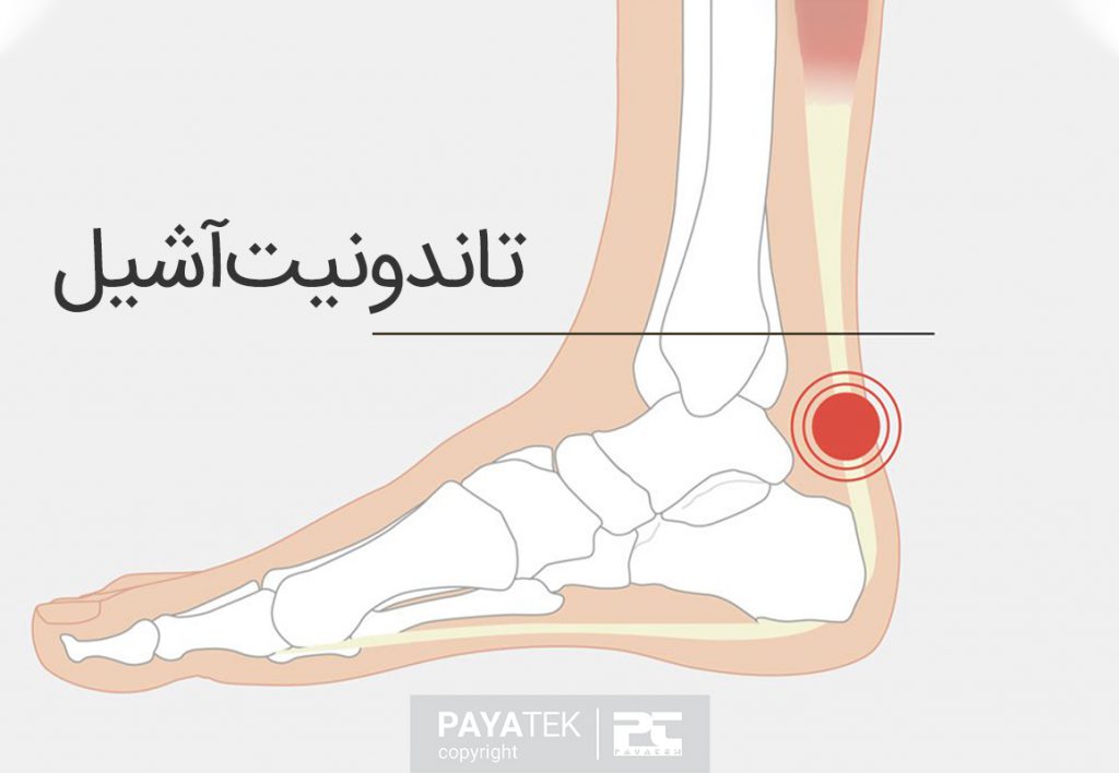 تاندون آشیل, دویدن