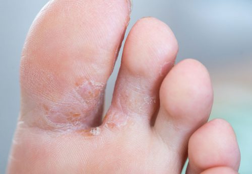  foot fungal infection   