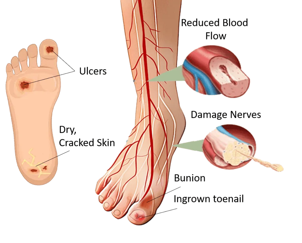 پای دیابتی - علائم مهمی که زنگ خطر افراد دیابتی است | پایاتک