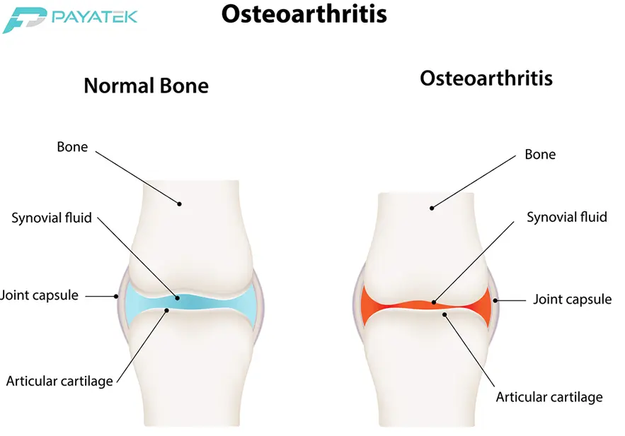 استئوآرتریت چیست؟ (osteoarthritis)